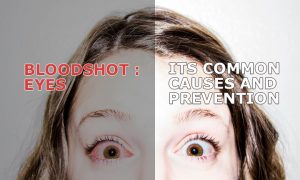 BLOODSHOT EYES ITS COMMON CAUSES AND PREVENTION