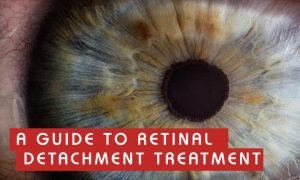 A guide to retinal detachment treatment