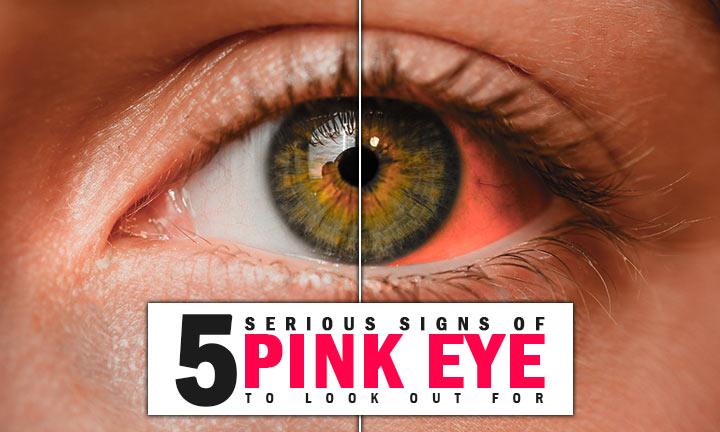 aigns of pink eye