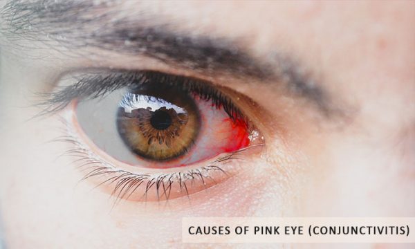 Causes Of Pink Eye Conjunctivitis
