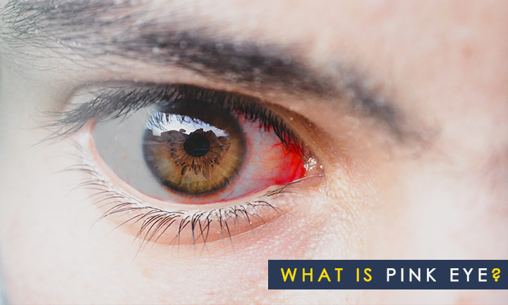 What-is-Pink-Eye