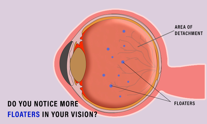 Do you notice more floaters in your vision?