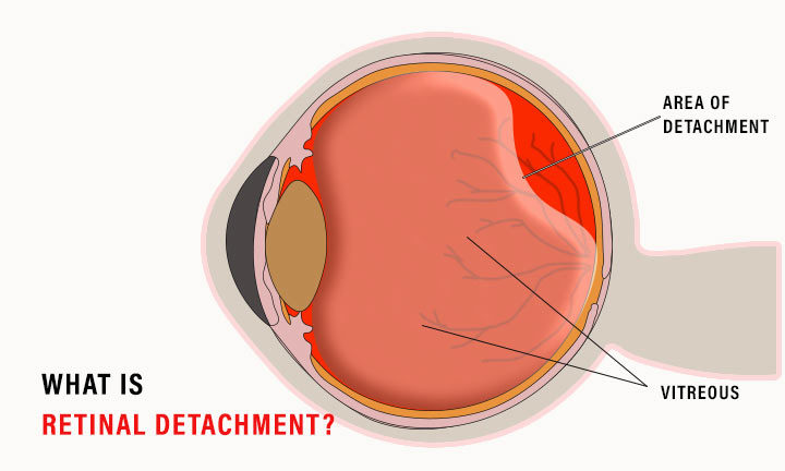 What is Retinal Detachment